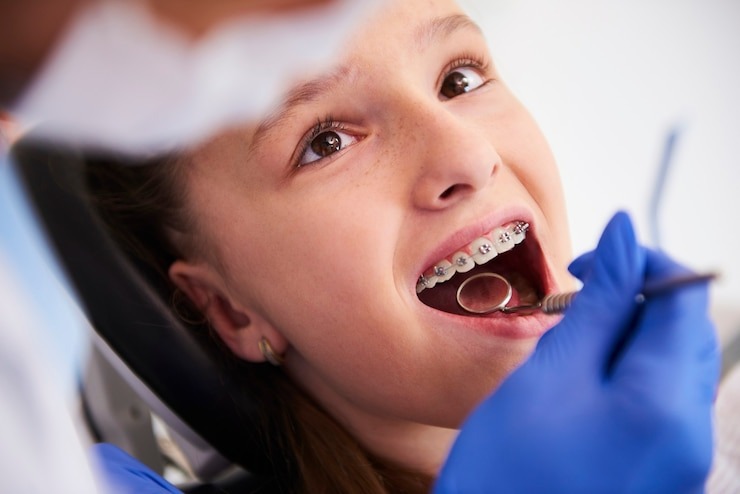 Having braces in Ottawa requires constant care by a dentist